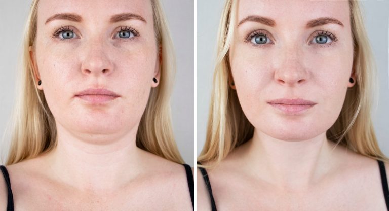 Kybella Before and After Photos: Visualizing Your Potential Results