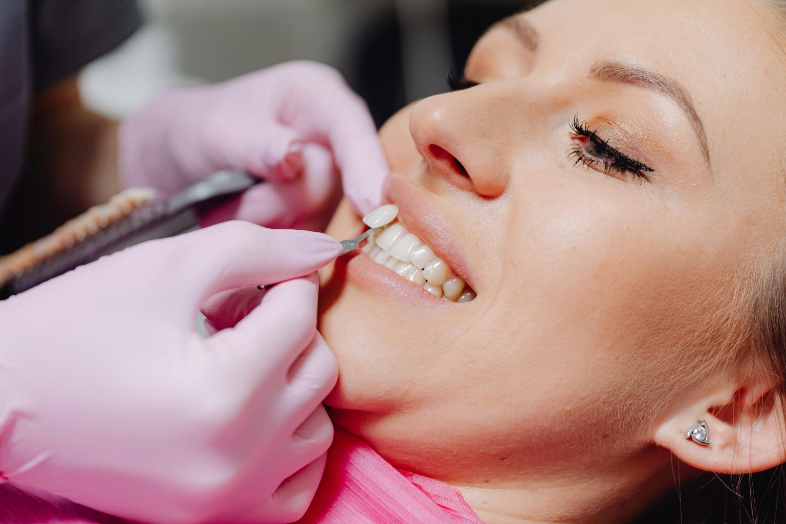 How Many Appointments Are Needed for Porcelain Veneers?